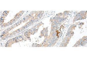 Immunohistochemistry of paraffin-embedded Human colorectal cancer tissue using GARNL3 Polyclonal Antibody at dilution of 1:60(x200) (GARNL3 Antikörper)