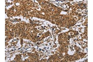 The image on the left is immunohistochemistry of paraffin-embedded Human gastric cancer tissue using ABIN7191086(IL31 Antibody) at dilution 1/20, on the right is treated with synthetic peptide. (IL-31 Antikörper)