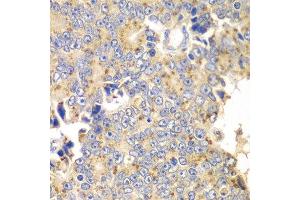 Immunohistochemistry of paraffin-embedded human prostate cancer using PICK1 antibody at dilution of 1:100 (x40 lens). (PICK1 Antikörper)