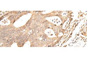 Immunohistochemistry of paraffin-embedded Human gastric cancer tissue using GRAP Polyclonal Antibody at dilution of 1:40(x200)