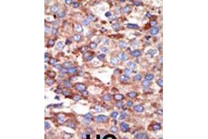 Formalin-fixed and paraffin-embedded human cancer tissue reacted with the primary antibody, which was peroxidase-conjugated to the secondary antibody, followed by DAB staining. (YY1 Antikörper  (AA 268-297))