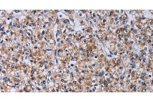 Immunohistochemistry of paraffin-embedded Human prostate cancer using CA4 Polyclonal Antibody at dilution of 1:30 (CA4 Antikörper)