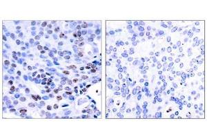 Immunohistochemical analysis of paraffin-embedded human breast carcinoma tissue using NF-κB p105/p50 (Ab-337) antibody (E021017). (NFKB1 Antikörper)
