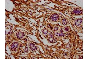 IHC image of ABIN7142837 diluted at 1:400 and staining in paraffin-embedded human breast cancer performed on a Leica BondTM system. (RPL7A Antikörper  (AA 2-138))