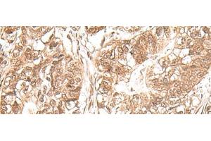 Immunohistochemistry of paraffin-embedded Human gastric cancer tissue using USP16 Polyclonal Antibody at dilution of 1:25(x200) (USP16 Antikörper)