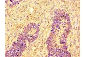 Immunohistochemistry of paraffin-embedded human ovarian cancer using ABIN7160009 at dilution of 1:100 (JNK Antikörper  (AA 5-300))