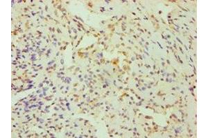 Immunohistochemistry of paraffin-embedded human breast cancer using ABIN7148700 at dilution of 1:100 (CRY1 Antikörper  (AA 507-586))