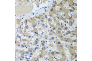 Immunohistochemistry of paraffin-embedded human liver cancer using XPC antibody at dilution of 1:100 (40x lens). (XPC Antikörper)