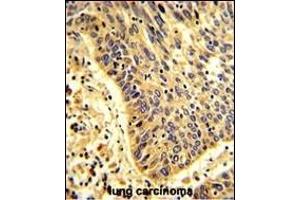 Formalin-fixed and paraffin-embedded human lung carcinoma with MyoGEF Antibody (N-term), which was peroxidase-conjugated to the secondary antibody, followed by DAB staining. (PLEKHG6 Antikörper  (N-Term))
