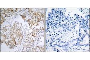 Immunohistochemistry analysis of paraffin-embedded human breast carcinoma, using IGF1R (Phospho-Tyr1161) Antibody. (IGF1R Antikörper  (pTyr1161))
