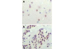 Immunohistochemical analysis of paraffin-embedded human cerebra (A) and breast carcinoma tissue (B), showing nuclear location. (NCOR1 Antikörper)