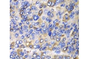 Immunohistochemistry of paraffin-embedded Human liver cancer using CES1 Polyclonal Antibody at dilution of 1:100 (40x lens). (CES1 Antikörper)