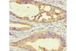 Immunohistochemistry of paraffin-embedded human colon cancer using ABIN7150645 at dilution of 1:100 (DMRTA1 Antikörper  (AA 201-504))