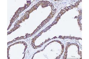 IHC analysis of Carbonic Anhydrase 9/CA9 using anti-Carbonic Anhydrase 9/CA9 antibody (ABIN7600076). (CA9 Antikörper  (AA 146-414))