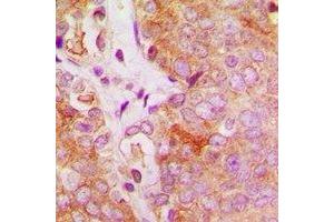 Immunohistochemical analysis of c-FER staining in human breast cancer formalin fixed paraffin embedded tissue section. (FER Antikörper)