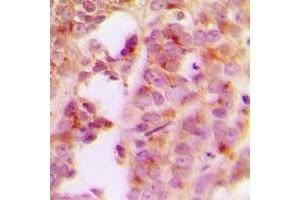 Immunohistochemical analysis of IRS1 staining in human breast cancer formalin fixed paraffin embedded tissue section. (IRS1 Antikörper  (Center))
