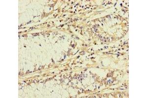 Immunohistochemistry of paraffin-embedded human colon cancer using ABIN7145543 at dilution of 1:100