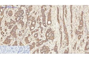 Immunohistochemistry of paraffin-embedded Human liver cancer tissue using AQP4 Monoclonal Antibody at dilution of 1:200. (Aquaporin 4 Antikörper)