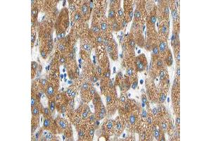 ABIN6266594 at 1/100 staining human liver carcinoma tissue sections by IHC-P. (MMP19 Antikörper  (N-Term))