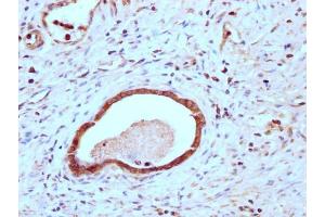 IHC image of ABIN7147892 diluted at 1:200 and staining in paraffin-embedded human gastric cancer performed on a Leica BondTM system. (Claudin 18 Antikörper  (AA 196-261))