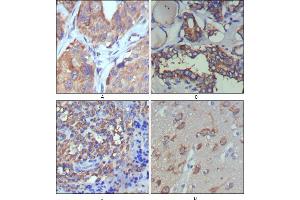 Immunohistochemical analysis of paraffin-embedded human lung cancer (A), thyroid cancer (B), lymph node (C) and brain (D) showing cytoplasmic and extracellular matrix localization using WNT5A mouse mAb with DAB staining.