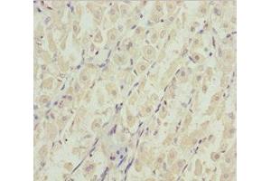 Immunohistochemistry of paraffin-embedded human gastric cancer using ABIN7144963 at dilution of 1:100 (DDX11 Antikörper  (AA 1-220))