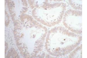 IHC staining of human rectal cancer tissue, diluted at 1:200. (CDX2 Antikörper)