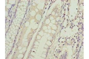 Immunohistochemistry of paraffin-embedded human colon cancer using ABIN7155160 at dilution of 1:100 (HIGD1B Antikörper  (AA 1-29))