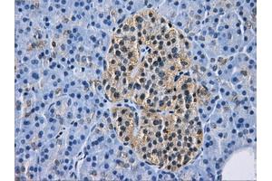 Immunohistochemical staining of paraffin-embedded Adenocarcinoma of breast tissue using anti-HDAC10 mouse monoclonal antibody. (HDAC10 Antikörper)