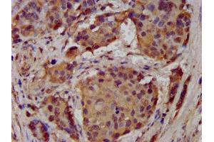 IHC image of ABIN7143000 diluted at 1:300 and staining in paraffin-embedded human pancreatic cancer performed on a Leica BondTM system. (ACCN1 Antikörper  (AA 197-345))