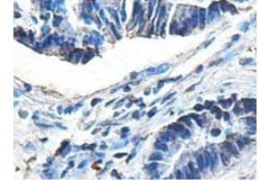 Immunohistochemical analysis of paraffin-embedded human colon carcinoma showing cytoplasmic staining with ACAD9 polyclonal antibody  at a 1 : 100 dilution. (ACAD9 Antikörper  (AA 1464-1642))