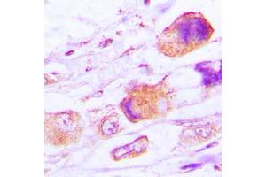 Immunohistochemical analysis of MRPL15 staining in human lung cancer formalin fixed paraffin embedded tissue section.
