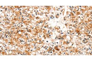 Immunohistochemistry of paraffin-embedded Human prostate cancer tissue using SLC25A12 Polyclonal Antibody at dilution 1:30 (SLC25A12 Antikörper)