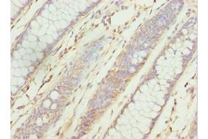 Immunohistochemistry of paraffin-embedded human colon cancer using ABIN7176126 at dilution of 1:100 (ZNF169 Antikörper  (AA 1-85))