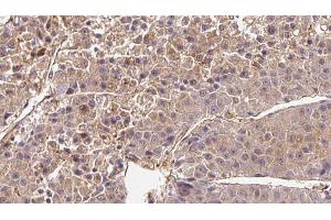 ABIN6272720 at 1/100 staining Human liver cancer tissue by IHC-P. (OR2B6 Antikörper  (Internal Region))