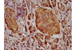 IHC image of ABIN7159545 diluted at 1:400 and staining in paraffin-embedded human pancreatic cancer performed on a Leica BondTM system. (MT3 Antikörper  (AA 1-68))