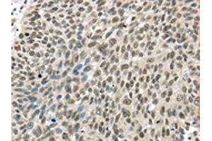 The image on the left is immunohistochemistry of paraffin-embedded Human lung cancer tissue using ABIN7131308(TBL1Y Antibody) at dilution 1/20, on the right is treated with fusion protein. (TBL1Y Antikörper)