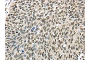 The image on the left is immunohistochemistry of paraffin-embedded Human lung cancer tissue using ABIN7131308(TBL1Y Antibody) at dilution 1/20, on the right is treated with fusion protein.