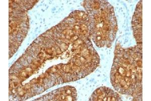 IHC testing of FFPE human colon carcinoma with MAML3 antibody (clone MAML3/1303). (MAML3 Antikörper)