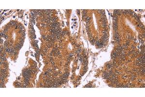 Immunohistochemistry of paraffin-embedded Human colon cancer tissue using CDC37L1 Polyclonal Antibody at dilution 1:60 (CDC37L1 Antikörper)