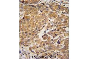 AWAT2 Antibody (C-term) immunohistochemistry analysis in formalin fixed and paraffin embedded human skin carcinoma followed by peroxidase conjugation of the secondary antibody and DAB staining. (AWAT2 Antikörper  (C-Term))