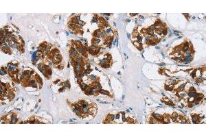 Immunohistochemistry of paraffin-embedded Human thyroid cancer using HINT2 Polyclonal Antibody at dilution of 1:50 (HINT2 Antikörper)