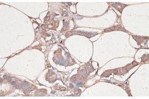 Immunohistochemistry of paraffin-embedded Human breast cancer using LAMC1 Polyclonal Antibody at dilution of 1:100 (40x lens). (Laminin gamma 1 Antikörper)