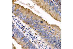 Immunohistochemistry of paraffin-embedded human colon cancer using IL9 antibody (ABIN5974970) at dilution of 1/200 (40x lens). (IL-9 Antikörper)