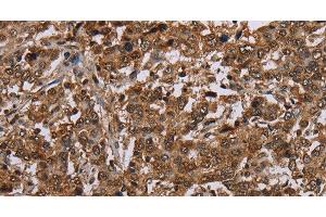 Immunohistochemistry of paraffin-embedded Human liver cancer using TBX5 Polyclonal Antibody at dilution of 1:35 (T-Box 5 Antikörper)