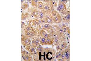 Formalin-fixed and paraffin-embedded human hepatocellular carcinoma reacted with IDE polyclonal antibody  , which was peroxidase-conjugated to the secondary antibody, followed by DAB staining. (IDE Antikörper  (Internal Region))