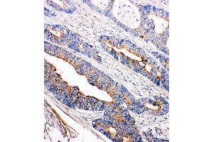 Anti-Tec antibody, IHC(P) IHC(P): Human Intestinal Cancer Tissue