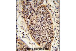 Formalin-fixed and paraffin-embedded human lung carcinoma reacted with XPA Antibody , which was peroxidase-conjugated to the secondary antibody, followed by DAB staining. (XPA Antikörper  (C-Term))