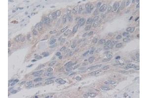 Detection of LACTb in Human Colorectal cancer Tissue using Polyclonal Antibody to Lactamase Beta (LACTb)