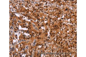 Immunohistochemistry of Human thyroid cancer using GPR124 Polyclonal Antibody at dilution of 1:40